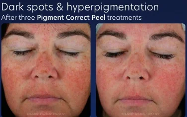 Before and after of dark spots and hyperpigmentation reduced after three PCA SKIN Pigment Correct Peel treatments