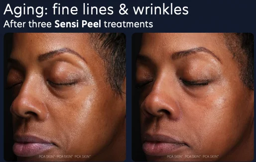 Before and after of fine lines and wrinkles softened after three PCA SKIN Sensi Peel treatments