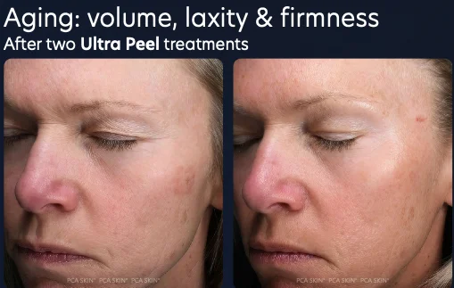 Before and after of improved volume, laxity, and firmness after two PCA SKIN Ultra Peel treatments